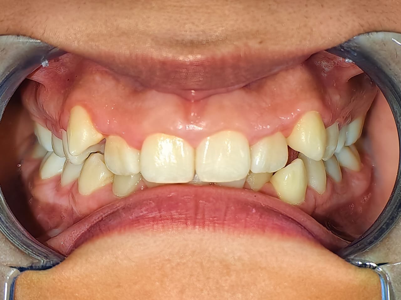 antes-tratamiento-ortodoncia