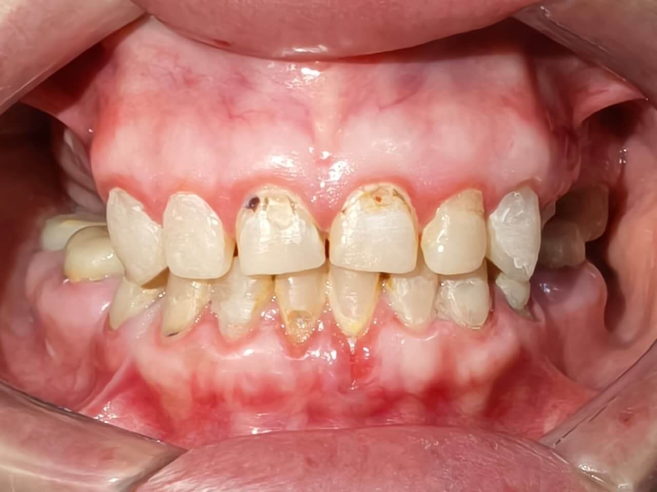 Rehabilitación Oral - Rehabilitación total con prótesis parciales y coronas individuales - Antes