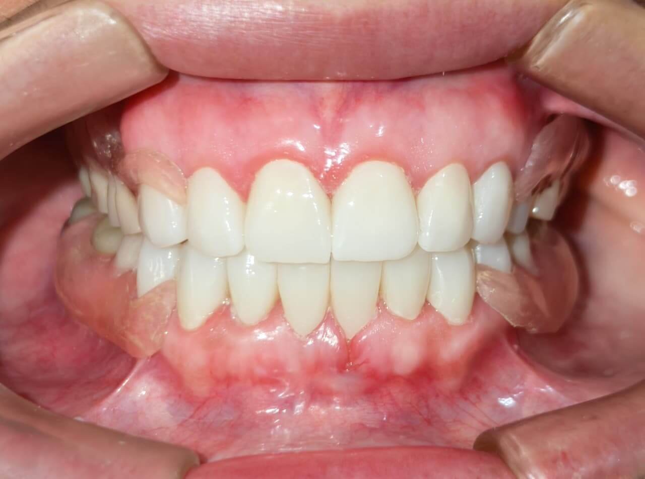 Rehabilitación Oral - Rehabilitación total con prótesis parciales y coronas individuales - Después